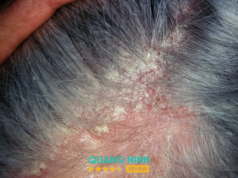 Phòng khám chuyên khoa da liễu bác sĩ Minh Tâm Hạ Long